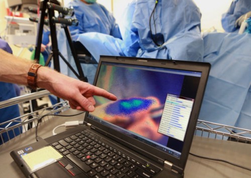 O Dr. Ryan Fields aponta para o gânglio linfático removido, visto na tela do computador como o é na tela do novo aparelho: em azul fluorescente. Crédito: Christian Gooden
