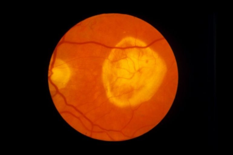 Pesquisadores esperam tratar a degeneração macular da retina com células-tronco pluripotentes induzidas. Imagem: Paul Parker; SPL