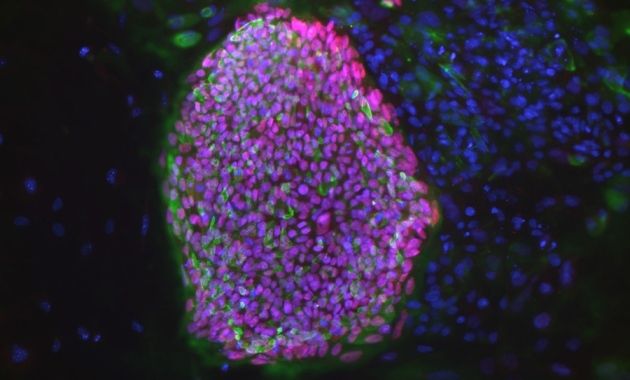 Colônia de células-tronco embrionárias obtidas através da clonagem de uma célula pertencente a uma mulher portadora de diabetes tipo 1. Pela primeira vez, cientistas demonstraram ser possível gerar células-tronco com embriões produzidos com o uso de células humanas adultas. Crédito: Bjarki Johannesson, NYSCF 