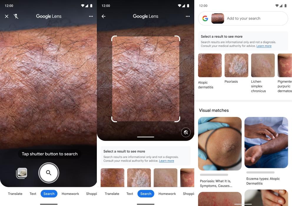 Google Lens Problema de pele